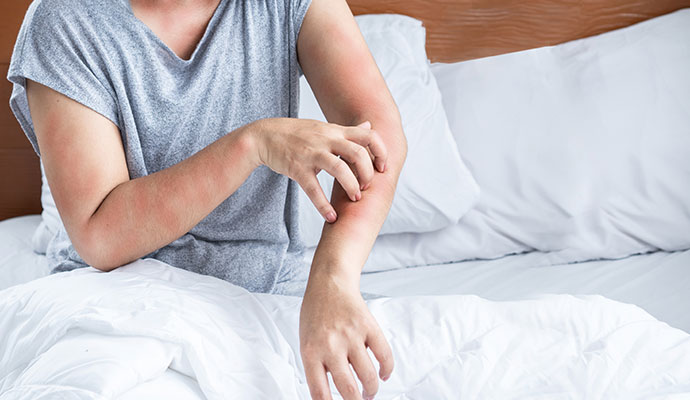 Person scratching red rash on hand